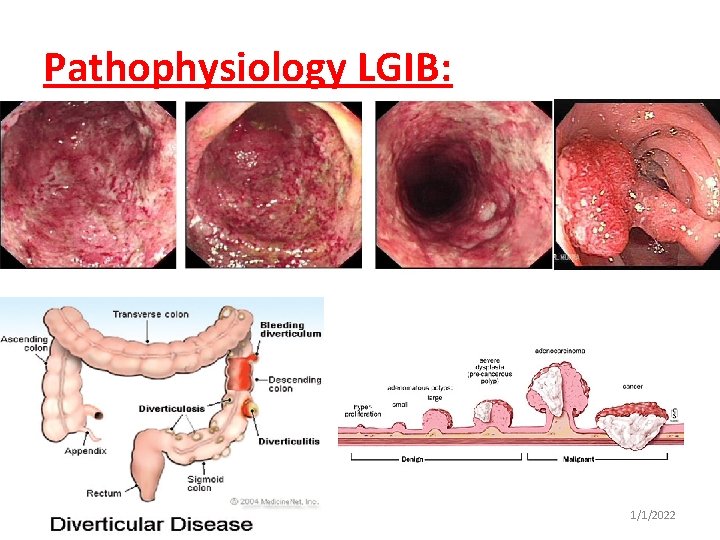 Pathophysiology LGIB: 1/1/2022 