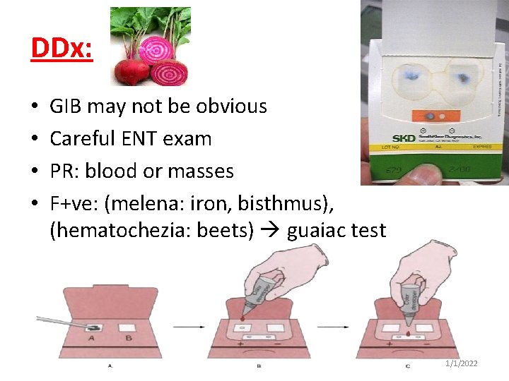 DDx: • • GIB may not be obvious Careful ENT exam PR: blood or