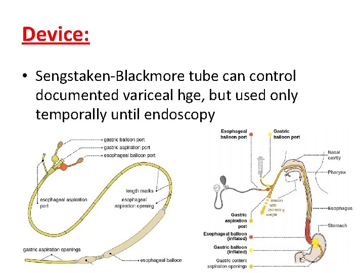 Device: • Sengstaken-Blackmore tube can control documented variceal hge, but used only temporally until