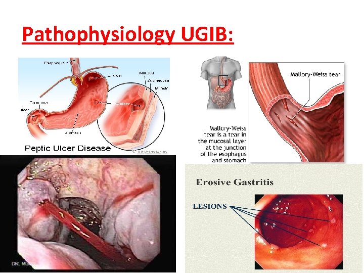Pathophysiology UGIB: 1/1/2022 