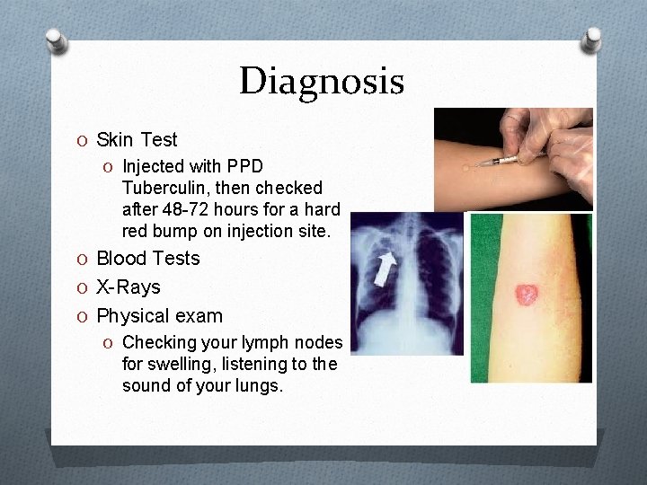 Diagnosis O Skin Test O Injected with PPD Tuberculin, then checked after 48 -72