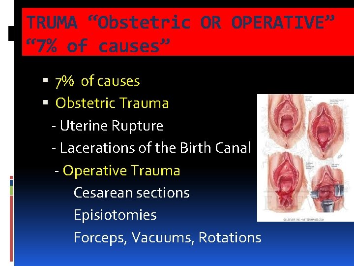 TRUMA “Obstetric OR OPERATIVE” “ 7% of causes” 7% of causes Obstetric Trauma - TRUMA “Obstetric OR OPERATIVE” “ 7% of causes” 7% of causes Obstetric Trauma -