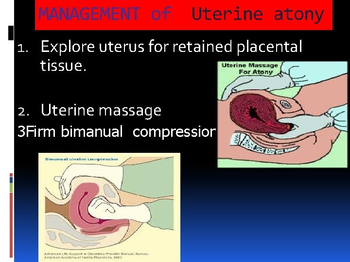 MANAGEMENT of Uterine atony 1. Explore uterus for retained placental tissue. 2. Uterine massage MANAGEMENT of Uterine atony 1. Explore uterus for retained placental tissue. 2. Uterine massage