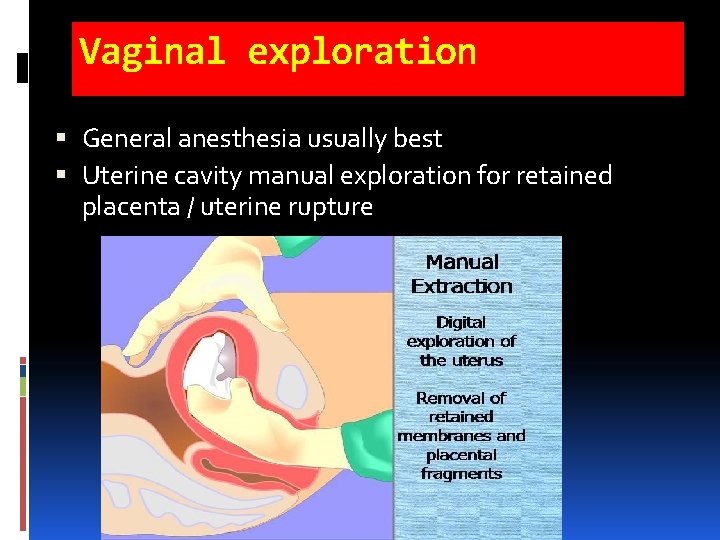 Vaginal exploration General anesthesia usually best Uterine cavity manual exploration for retained placenta / Vaginal exploration General anesthesia usually best Uterine cavity manual exploration for retained placenta /