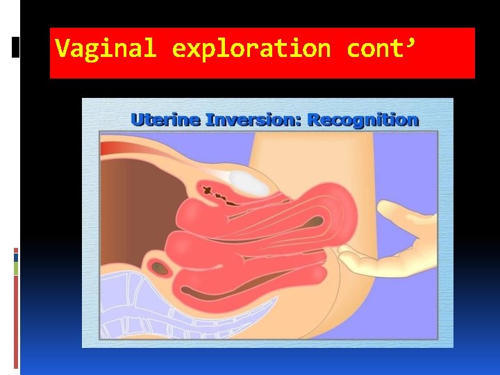 Vaginal exploration cont’ Vaginal exploration cont’