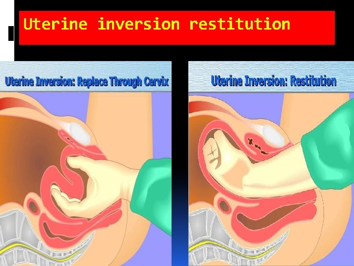 Uterine inversion restitution Uterine inversion restitution