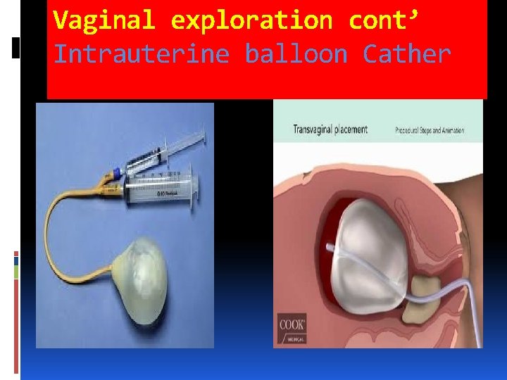 Vaginal exploration cont’ Intrauterine balloon Cather Vaginal exploration cont’ Intrauterine balloon Cather
