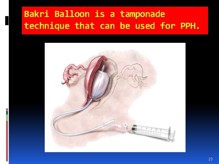 Bakri Balloon is a tamponade technique that can be used for PPH. 23 Bakri Balloon is a tamponade technique that can be used for PPH. 23