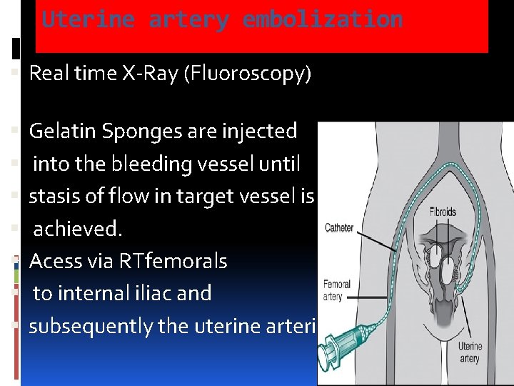 Uterine artery embolization Real time X-Ray (Fluoroscopy) Gelatin Sponges are injected into the bleeding Uterine artery embolization Real time X-Ray (Fluoroscopy) Gelatin Sponges are injected into the bleeding