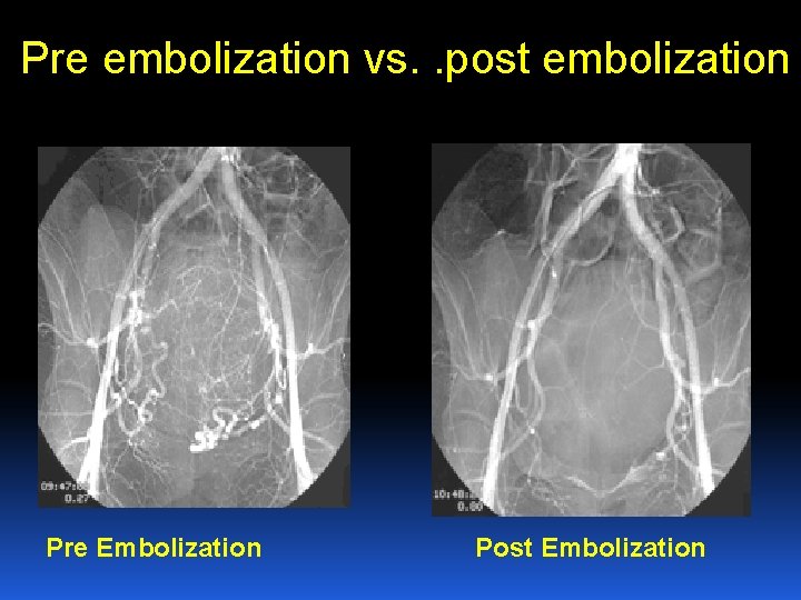 Pre embolization vs. . post embolization Pre Embolization Post Embolization Pre embolization vs. . post embolization Pre Embolization Post Embolization