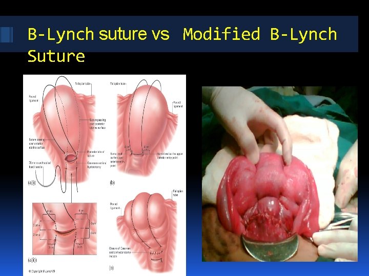 B-Lynch suture vs Modified B-Lynch Suture B-Lynch suture vs Modified B-Lynch Suture