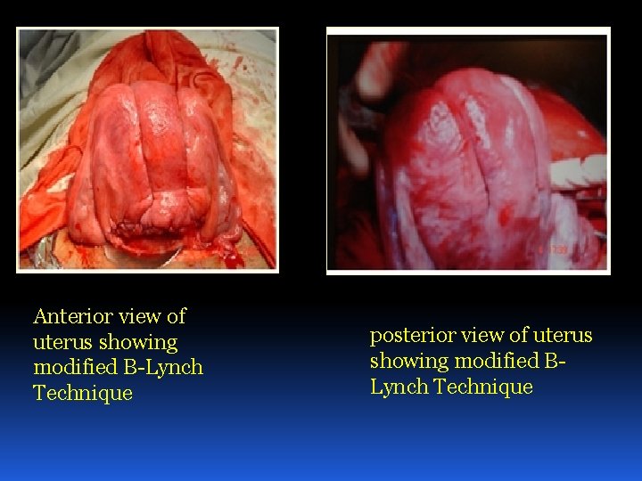 Anterior view of uterus showing modified B-Lynch Technique posterior view of uterus showing modified Anterior view of uterus showing modified B-Lynch Technique posterior view of uterus showing modified