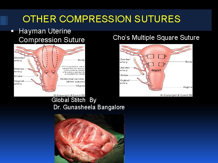 OTHER COMPRESSION SUTURES Hayman Uterine Compression Suture Cho’s Multiple Square Suture Global Stitch By OTHER COMPRESSION SUTURES Hayman Uterine Compression Suture Cho’s Multiple Square Suture Global Stitch By