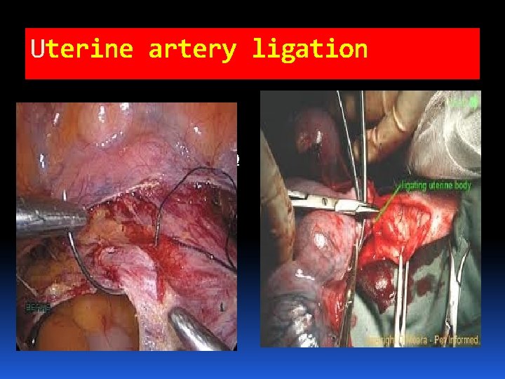 Uterine artery ligation http: //t 3. gstatic. com/i mages? q=tbn: ANd 9 Gc QOa. Uterine artery ligation http: //t 3. gstatic. com/i mages? q=tbn: ANd 9 Gc QOa.