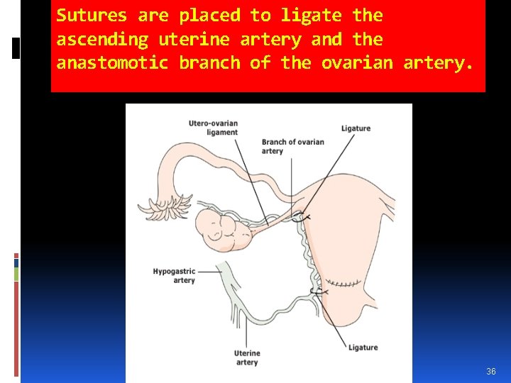 Sutures are placed to ligate the ascending uterine artery and the anastomotic branch of Sutures are placed to ligate the ascending uterine artery and the anastomotic branch of
