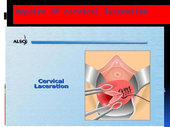 Repaire of cervical laceration Palpate uterine cavity to assure its integrity Full thickness mucosal Repaire of cervical laceration Palpate uterine cavity to assure its integrity Full thickness mucosal