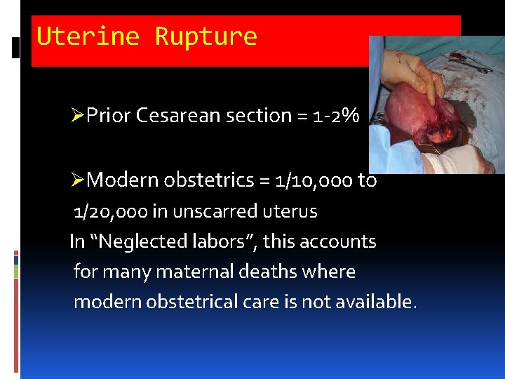 Uterine Rupture ØPrior Cesarean section = 1 -2% ØModern obstetrics = 1/10, 000 to Uterine Rupture ØPrior Cesarean section = 1 -2% ØModern obstetrics = 1/10, 000 to