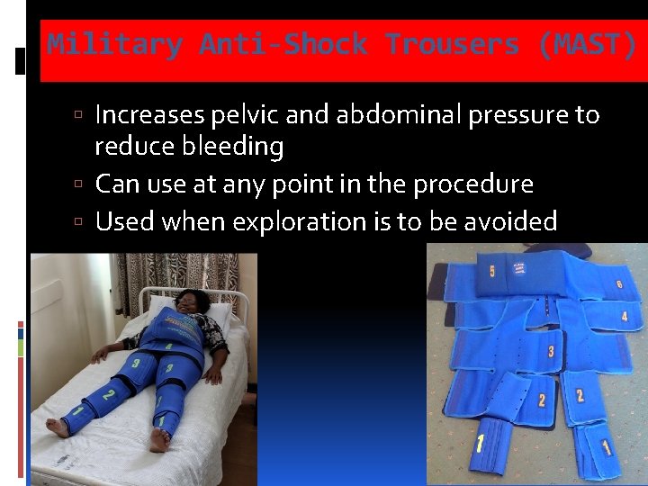 Military Anti-Shock Trousers (MAST) Increases pelvic and abdominal pressure to reduce bleeding Can use Military Anti-Shock Trousers (MAST) Increases pelvic and abdominal pressure to reduce bleeding Can use