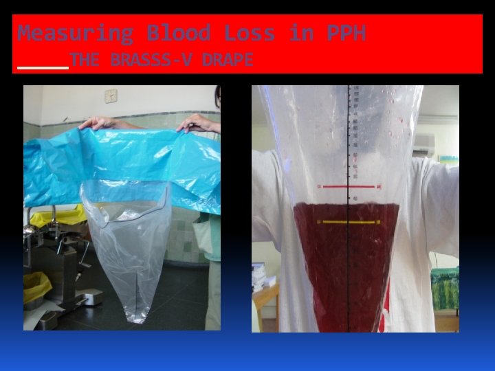 Measuring Blood Loss in PPH THE BRASSS-V DRAPE Measuring Blood Loss in PPH THE BRASSS-V DRAPE