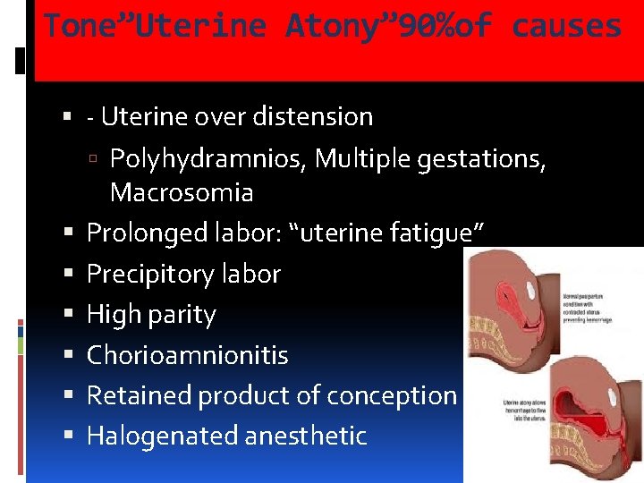 Tone”Uterine Atony” 90%of causes - Uterine over distension Polyhydramnios, Multiple gestations, Macrosomia Prolonged labor: Tone”Uterine Atony” 90%of causes - Uterine over distension Polyhydramnios, Multiple gestations, Macrosomia Prolonged labor: