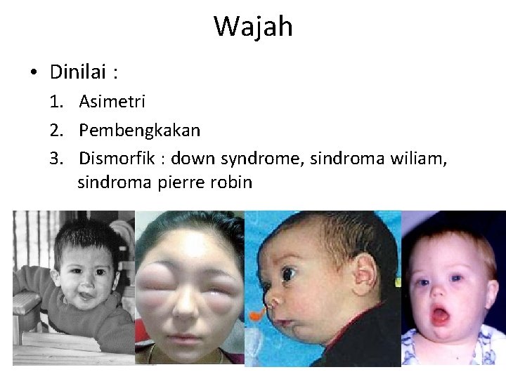 Wajah • Dinilai : 1. Asimetri 2. Pembengkakan 3. Dismorfik : down syndrome, sindroma