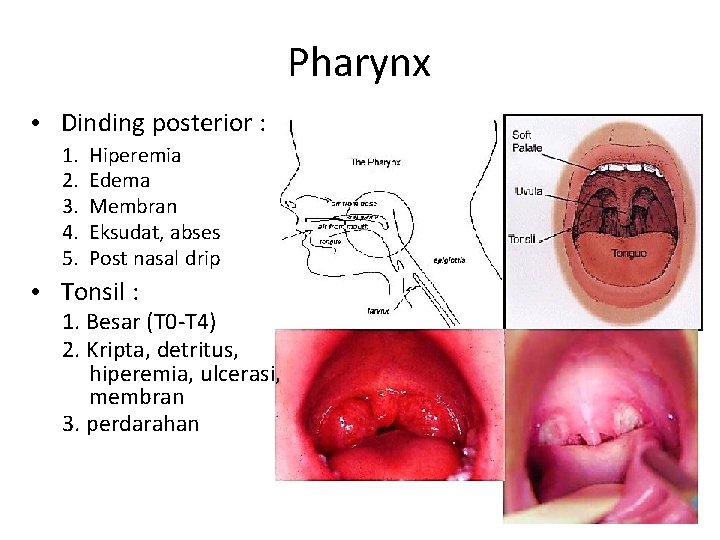 Pharynx • Dinding posterior : 1. 2. 3. 4. 5. Hiperemia Edema Membran Eksudat,