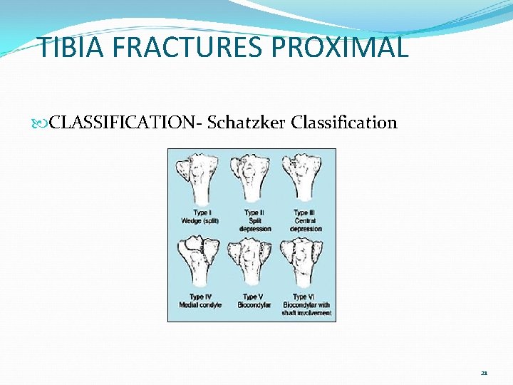 TIBIA FRACTURES PROXIMAL CLASSIFICATION- Schatzker Classification 21 