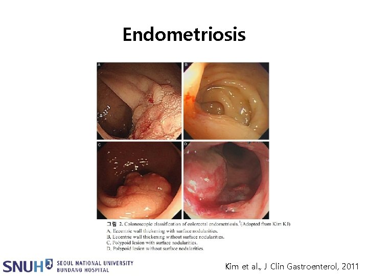 Endometriosis Kim et al. , J Clin Gastroenterol, 2011 