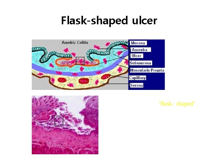 Flask-shaped ulcer 