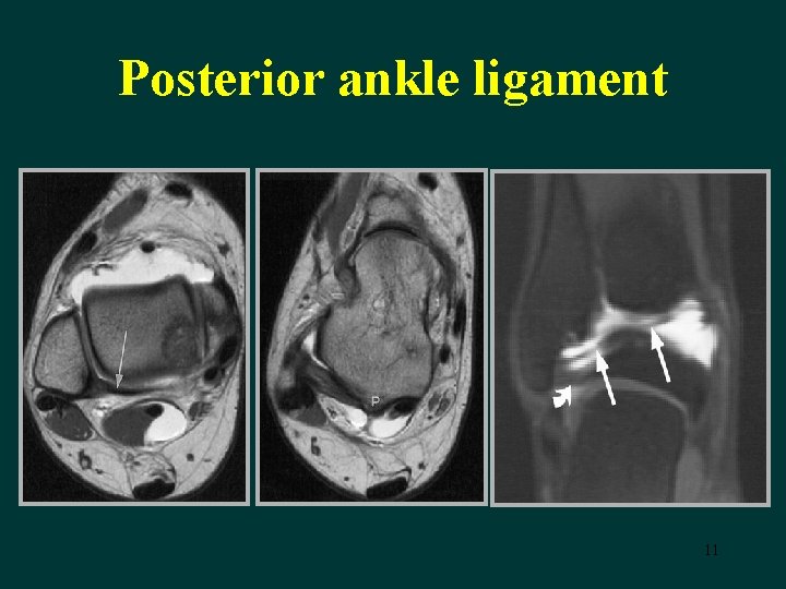 Posterior ankle ligament 11 