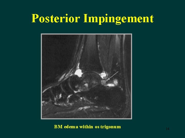 Posterior Impingement BM edema within os trigonum 14 