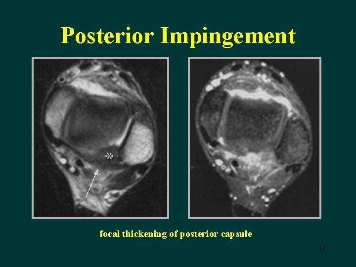 Ankle Impingement Syndrome initial ankle injury abnormal osseous