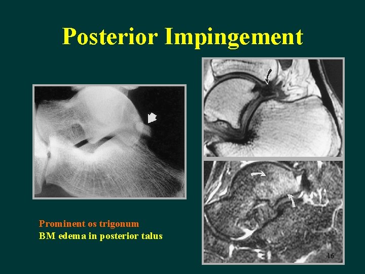 Posterior Impingement Prominent os trigonum BM edema in posterior talus 16 