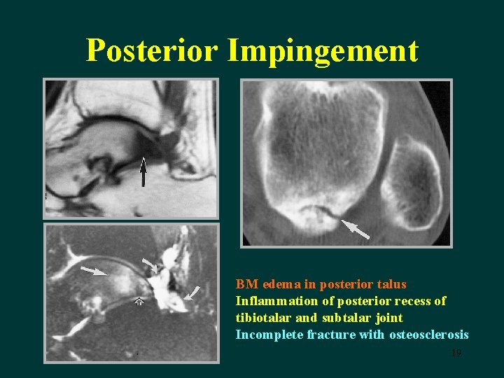 Posterior Impingement BM edema in posterior talus Inflammation of posterior recess of tibiotalar and