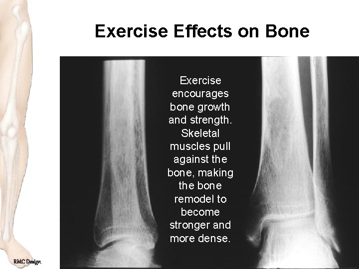 Exercise Effects on Bone Exercise encourages bone growth and strength. Skeletal muscles pull against