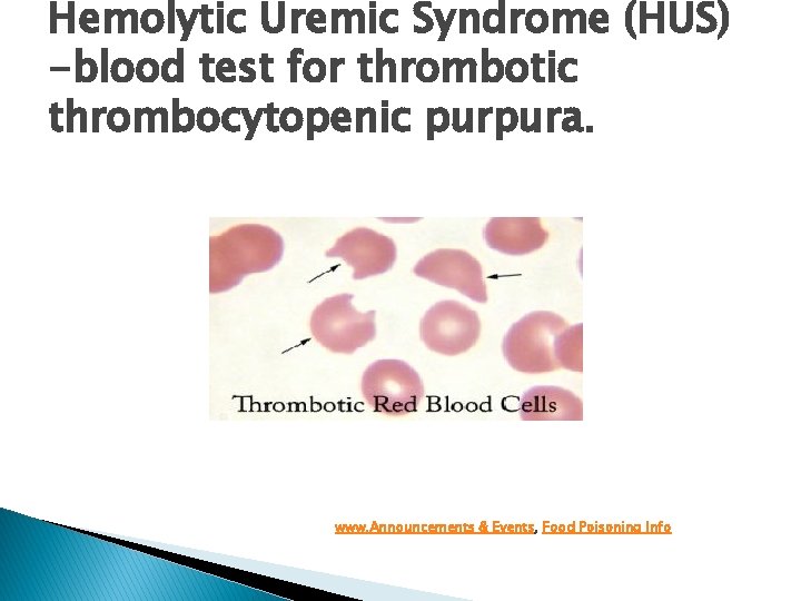 Hemolytic Uremic Syndrome (HUS) -blood test for thrombotic thrombocytopenic purpura. www. Announcements & Events,