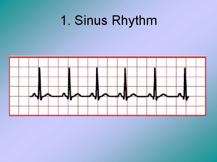 1. Sinus Rhythm 