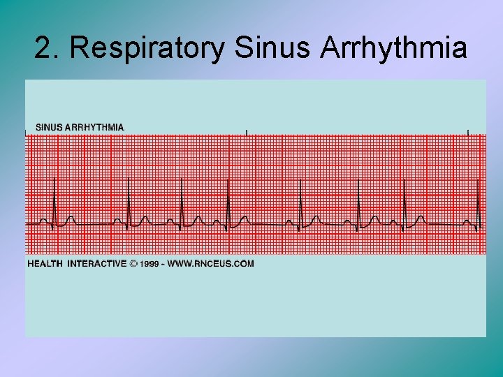 2. Respiratory Sinus Arrhythmia 