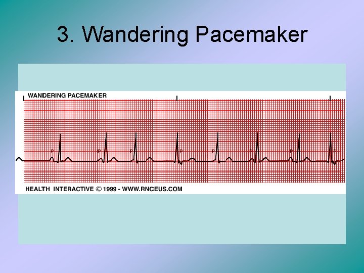 3. Wandering Pacemaker 