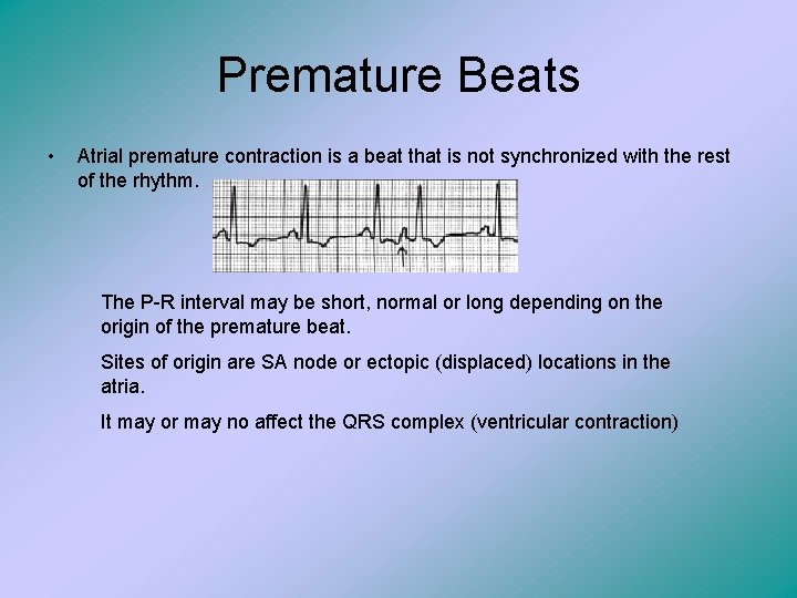 Premature Beats • Atrial premature contraction is a beat that is not synchronized with