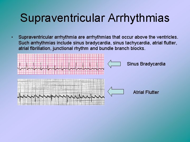 Supraventricular Arrhythmias • Supraventricular arrhythmia are arrhythmias that occur above the ventricles. Such arrhythmias