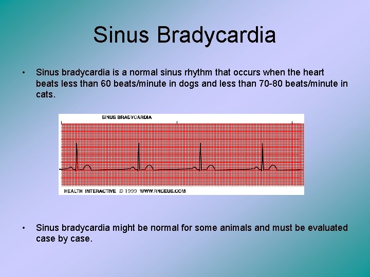 Sinus Bradycardia • Sinus bradycardia is a normal sinus rhythm that occurs when the