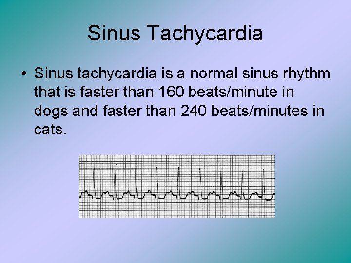 Sinus Tachycardia • Sinus tachycardia is a normal sinus rhythm that is faster than