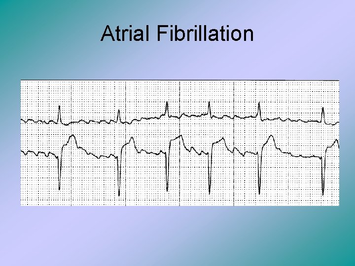 Atrial Fibrillation 