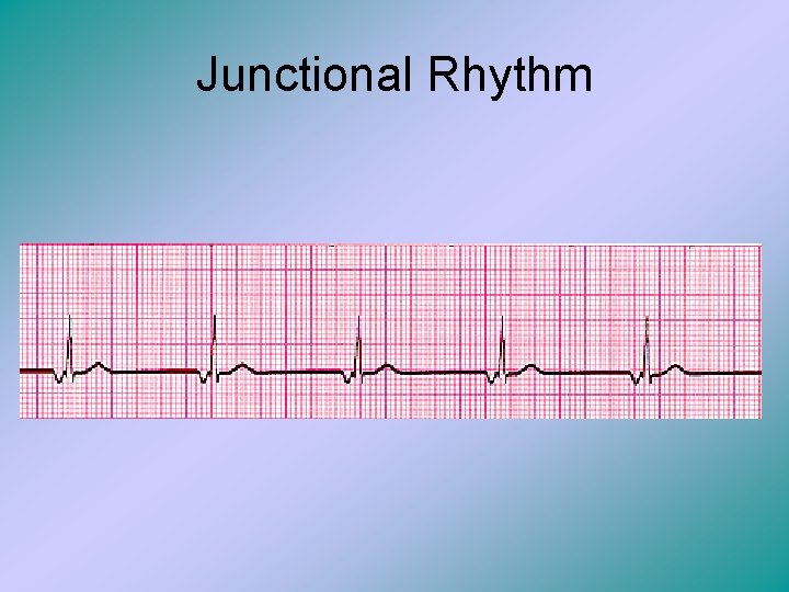 Junctional Rhythm 