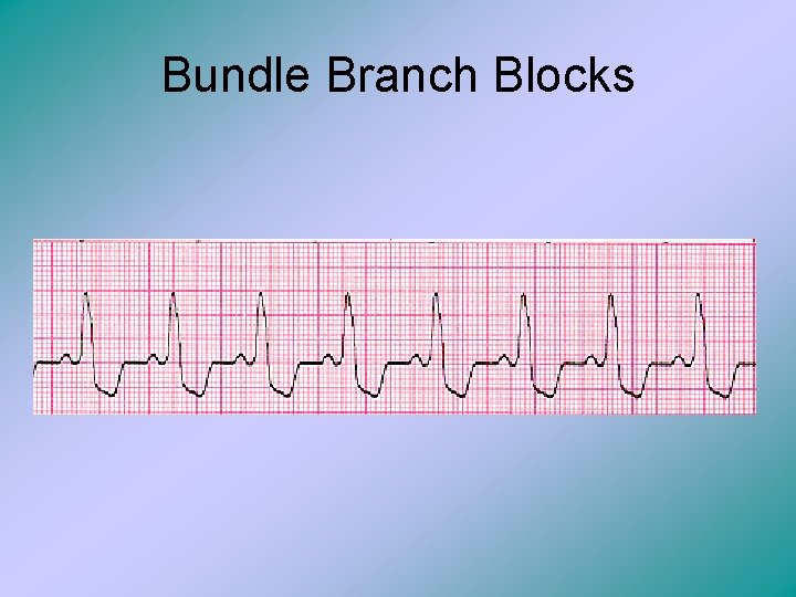 Bundle Branch Blocks 