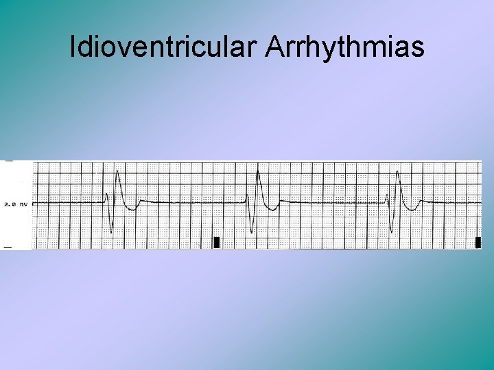 Idioventricular Arrhythmias 