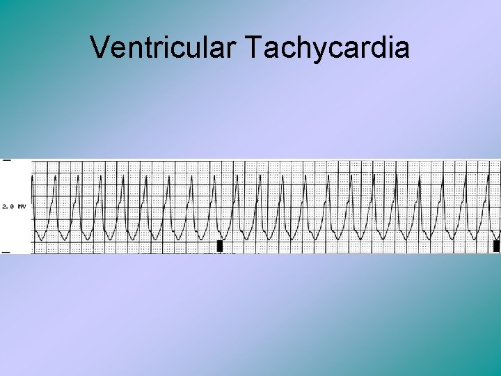 Ventricular Tachycardia 