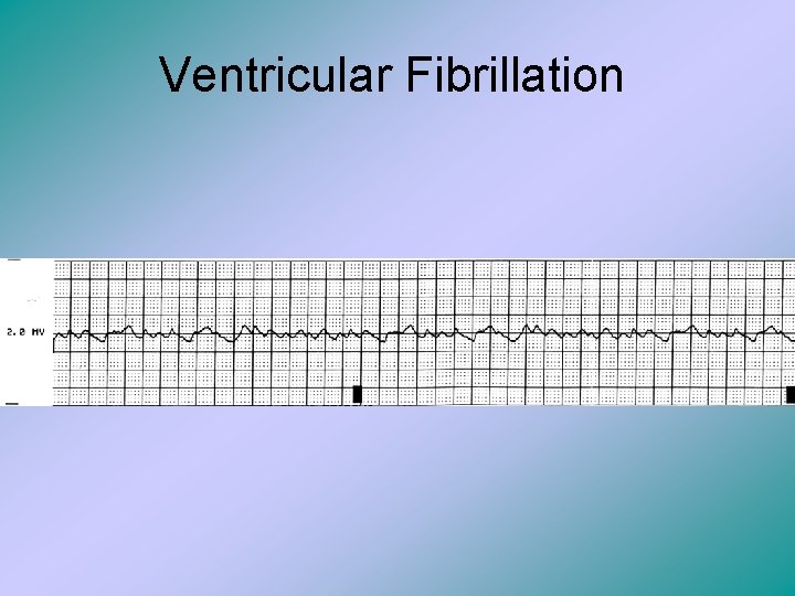 Ventricular Fibrillation 