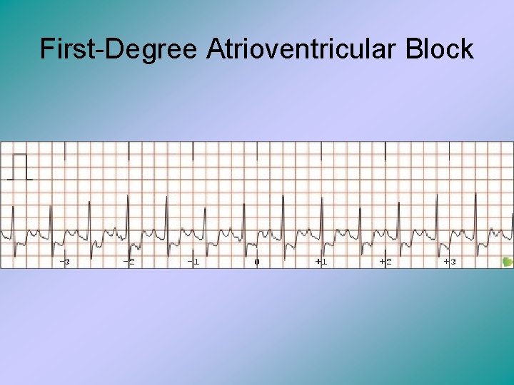 First-Degree Atrioventricular Block 